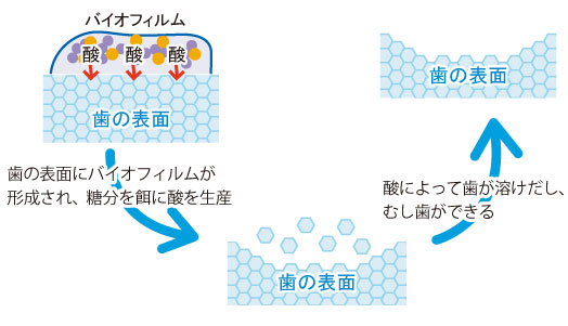 バイオフィルムによってむし歯ができるまで