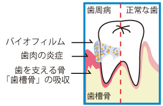 バイオフィルムが引き起こす歯周病