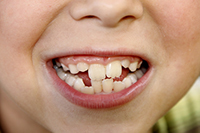 歯並びの悪い混合歯列期の子ども