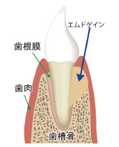 エムドゲイン治療法の図