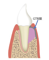 GTR法とはどんな治療か