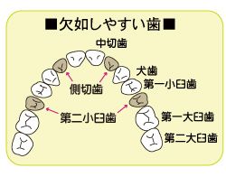 欠如しやすい歯の場所