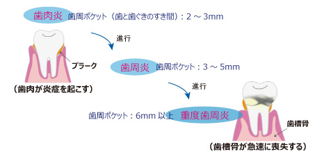 歯周病の進行図（歯肉炎から歯周炎へ）