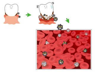 血管内を巡る歯周病菌