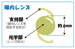 眼内レンズとは