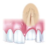 歯の埋入